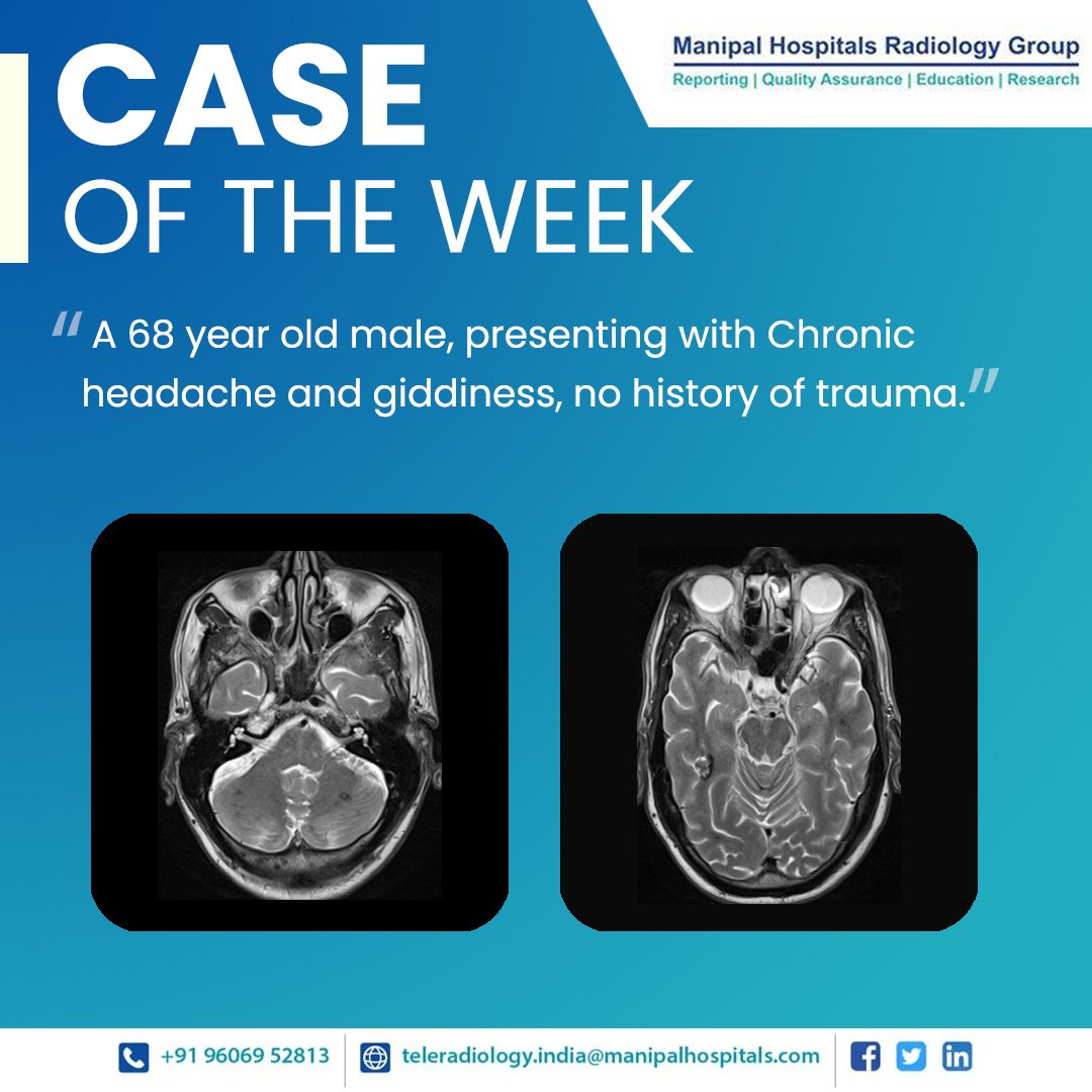 ManipalMhrg's tweet photo. Presenting our #CaseOfTheWeek - A 68 years Male, presenting with chronic headache and giddiness, no history of trauma.
For more read on: https://t.co/Pq7cu9VAao
#radiologyy #teleradiology #MHRG #subspecialty #CaseOfTheWeek https://t.co/Fc7qqL4dQp