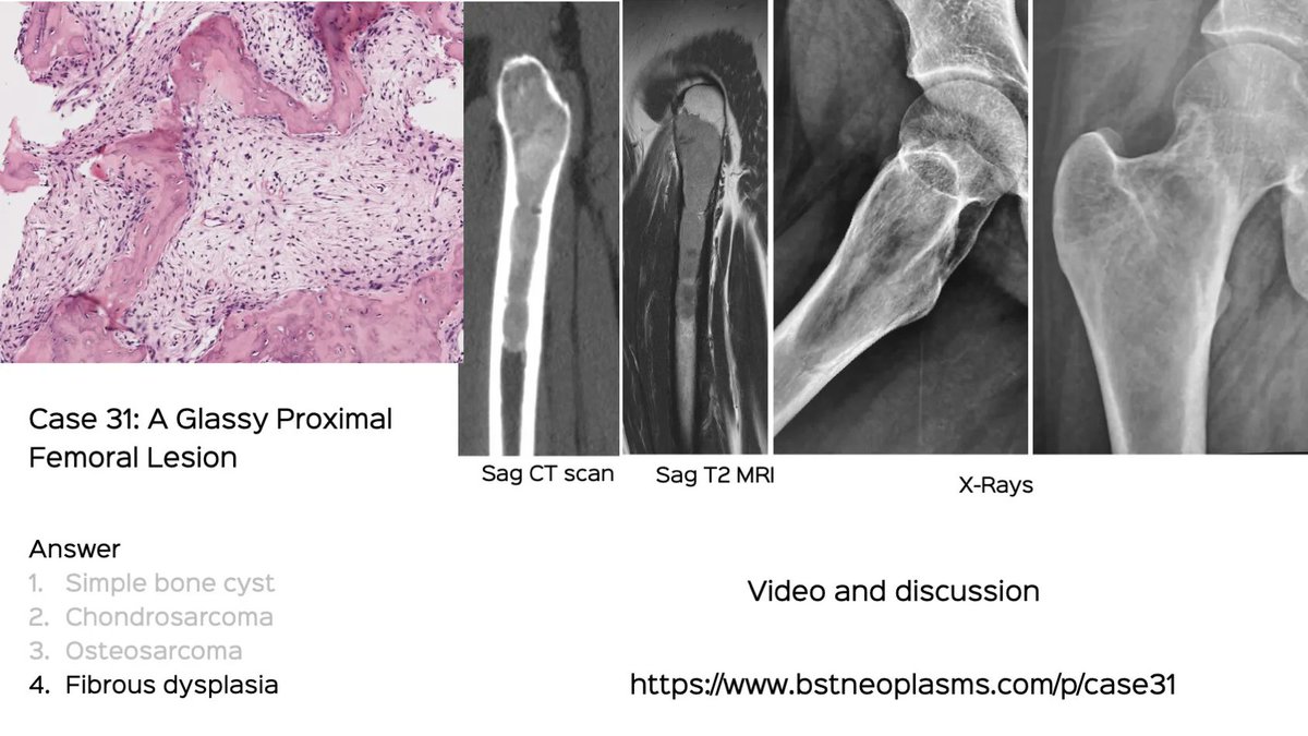 Case 31: A Glassy Proximal Femoral Lesion

Answer is up with a discussion video

bstneoplasms.com/p/case31

#bstneoplasms #bonetumor #radres  #femur #fibrousdysplasia