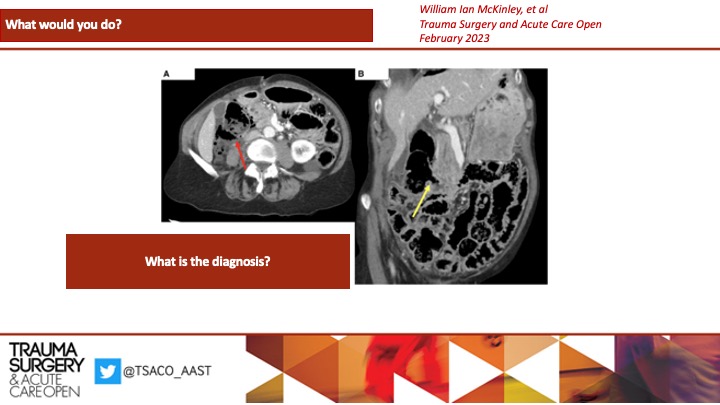 TSACO_AAST's tweet photo. #WWYDWEDNESDAYS π€
Case:
βͺοΈ 70sF with 2hrs of RLQ 10/10 pain
βͺοΈ Peritonitis on exam
βͺοΈ BMP + CBC all WNL. Lactic acid 3.4 (nrml<2).
βͺοΈ IVF resuscitation + antibiotics started.
π
CT images attached.
π€ What is the diagnosis?
#SoMe4Surgery #TSACOGLOBAL #acutecaresurgery https://t.co/BucrnRVIrF