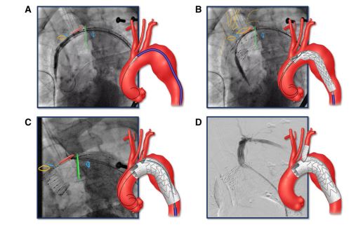 #ShortCommunication 📖
Early Feasibility of #Endovascular Repair of Distal Aortic Arch #Aneurysms Using Patient-Specific Single Retrograde Left Subclavian Artery Branch #Stent Graft
link.springer.com/article/10.100…
@GustavoOderich