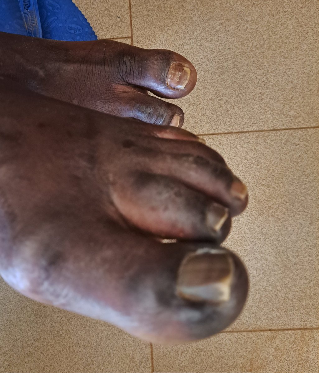 Differential Diagnosis? #HemeTwitter #dermtwitter #MedEd #MedTwitter #Rheumatology #Immunology
27y/M no known chronic illness history of fever & GBW, and 2days h/o painful small joints & darkening of the digits.