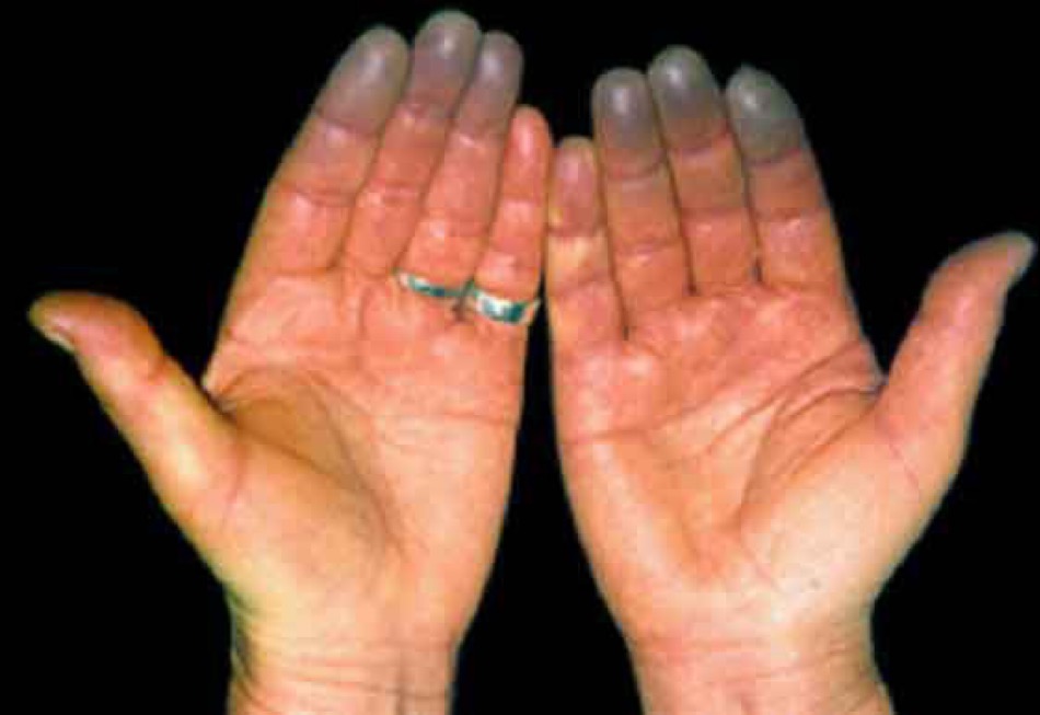 BrownJHM's tweet photo. A 30-year-old male w/ a 20 pack year smoking hx presented with pain &amp; discoloration in both hands. He began having pain in his hands about 1 wk earlier &amp; noticed discoloration at the tips. Pulses in both upper extremities were diminished. What is the likely diagnosis? #MedTwitter https://t.co/nqug7XOGag