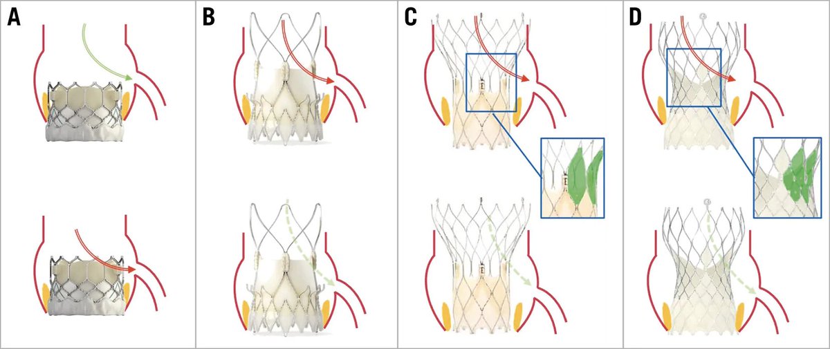 Fresh off the press: 
Practical clinical guidance on the management of #CAD in #TAVI patients 
by the #EAPCI and the ESC WG on CV Surgery
<a href="/escardio/">European Society of Cardiology</a> <a href="/ESC_Journals/">European Society of Cardiology Journals</a> <a href="/EuroInterventio/">EuroIntervention</a> <a href="/EAPCIPresident/">EAPCIPresident</a> <a href="/G_Tarantini01/">Giuseppe_Tarantini</a> <a href="/LarsSondergaard/">Lars Søndergaard</a> <a href="/GilbertTangMD/">Dr. Gilbert Tang</a> 
eurointervention.pcronline.com/article/manage…
