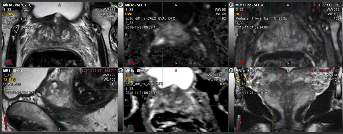 PIRADS2.1= T2 is dominant sequence in TZ, AFMS &amp; CZ!!  May not be the case always!! examples 👇!!. <a href="/SAR_ProstateDFP/">SAR Prostate DFP</a> <a href="/arganz_online/">ARGANZ</a> <a href="/ProfPadhani/">Anwar Padhani</a> <a href="/JelleBarentsz/">Jelle Barentsz</a> <a href="/TarlintonLisa/">Lisa Tarlinton</a>