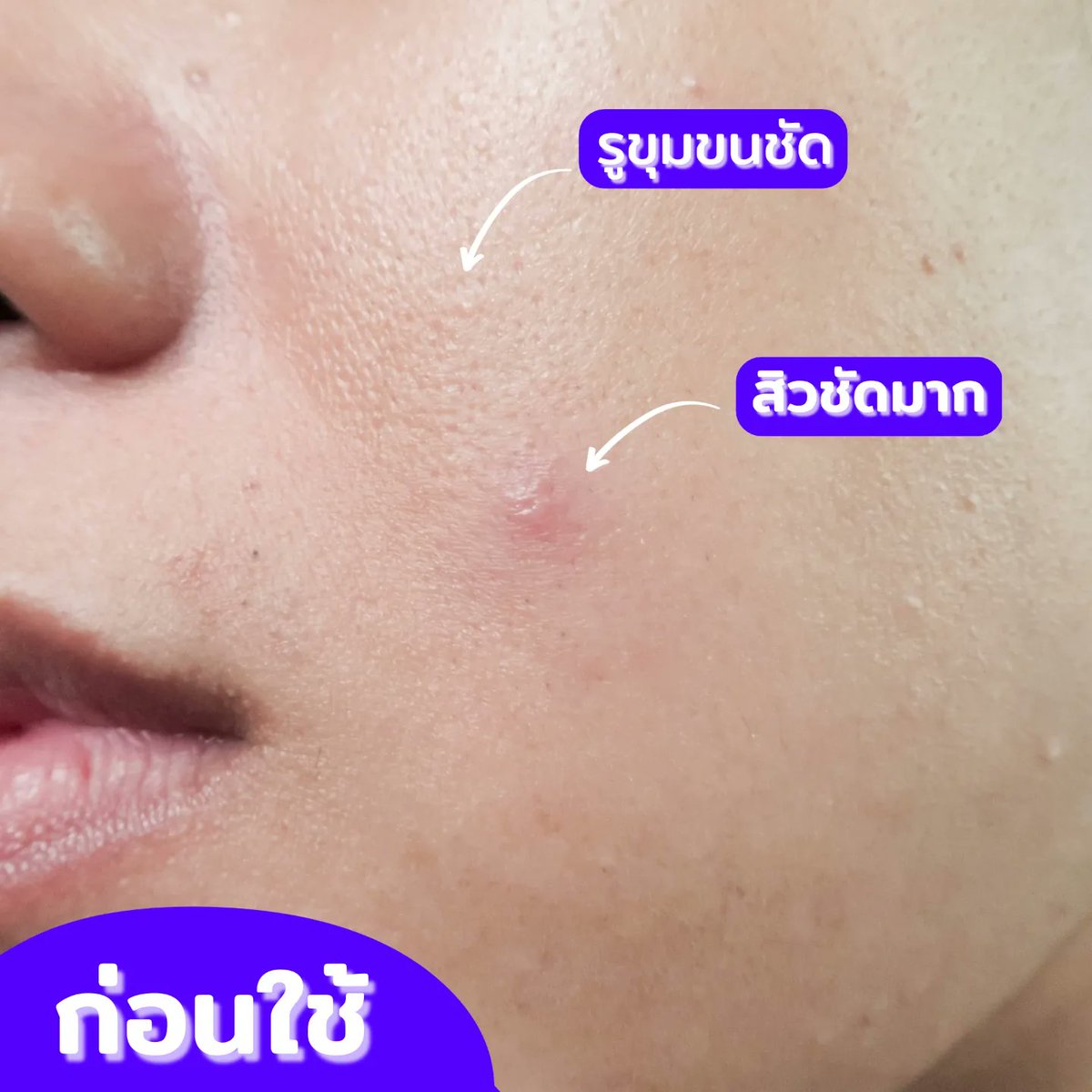 PEARY_OFFICIAL's tweet photo. #มอยเจอร์ไรเซอร์บำรุงผิว Acnergic Moisturizing Cream #ลดสิว #ลดผด #กระชับรูขุมขน #ฟื้นฟูผิวให้แข็งแรง เซรั่มสูตรออร์แกนิก ทำมาเพื่อตอบโจทย์คนที่เป็นสิว ผิวแพ้ง่ายโดยเฉพาะ อ่อนโยนเป็นพิเศษ คนที่ผิวติดสารสเตียรอยต์ หรือ คนท้องก็ใช้ได้ ✨
#เภสัชจ๋าสิวลาก่อน #รีวิว #รักษาสิว #เซรั่ม https://t.co/bbzwRH9L6J