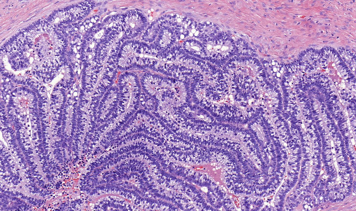 kiko4docs's tweet photo. Lung mass from an adult shared by Dr. @TristanRutland7. 
Diagnosis? What gene mutation is often present?
Answers: https://t.co/PBSN1k3uXU
More posts by Dr. Rutland on his Kiko profile: https://t.co/xCtRyZHvPC
#pulmpath #pathologists #pathology #pathTwitter https://t.co/hiDNWBwJrp