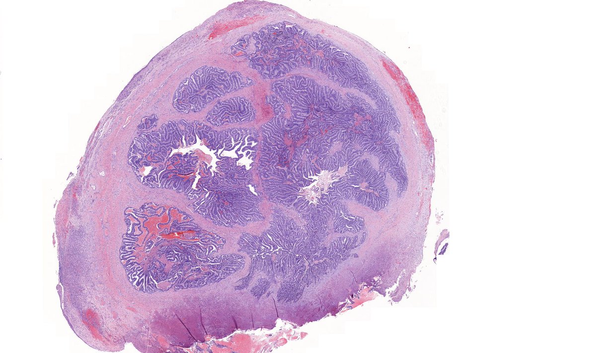 kiko4docs's tweet photo. Lung mass from an adult shared by Dr. @TristanRutland7. 
Diagnosis? What gene mutation is often present?
Answers: https://t.co/PBSN1k3uXU
More posts by Dr. Rutland on his Kiko profile: https://t.co/xCtRyZHvPC
#pulmpath #pathologists #pathology #pathTwitter https://t.co/hiDNWBwJrp