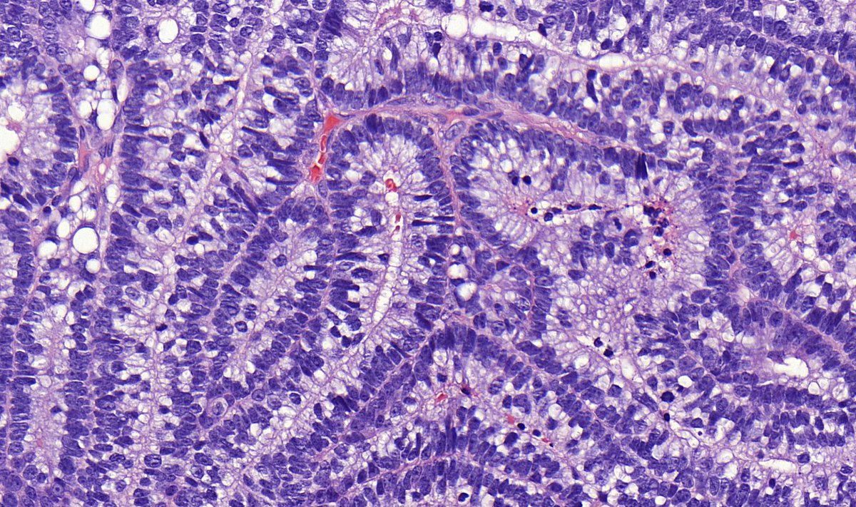 kiko4docs's tweet photo. Lung mass from an adult shared by Dr. @TristanRutland7. 
Diagnosis? What gene mutation is often present?
Answers: https://t.co/PBSN1k3uXU
More posts by Dr. Rutland on his Kiko profile: https://t.co/xCtRyZHvPC
#pulmpath #pathologists #pathology #pathTwitter https://t.co/hiDNWBwJrp