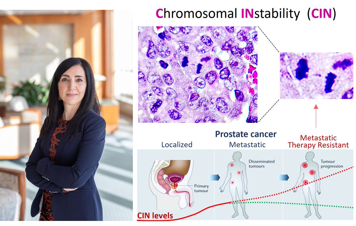 Mayo Clinic Urology (@mayourology) on Twitter photo A <a href="/MayoUrology/">Mayo Clinic Urology</a> paper just published <a href="/CellRepMed/">Cell Reports Medicine</a> found a new therapeutic vulnerability of lethal prostate cancer. Dr. <a href="/VRodriguezBravo/">Veronica R Bravo</a> team uncovered how a tumor’s high chromosomal instability (CIN) can be turned against itself. bit.ly/3XSKvLh #ProstateCancer #Urology A <a href="/MayoUrology/">Mayo Clinic Urology</a> paper just published <a href="/CellRepMed/">Cell Reports Medicine</a> found a new therapeutic vulnerability of lethal prostate cancer. Dr. <a href="/VRodriguezBravo/">Veronica R Bravo</a> team uncovered how a tumor’s high chromosomal instability (CIN) can be turned against itself. bit.ly/3XSKvLh #ProstateCancer #Urology