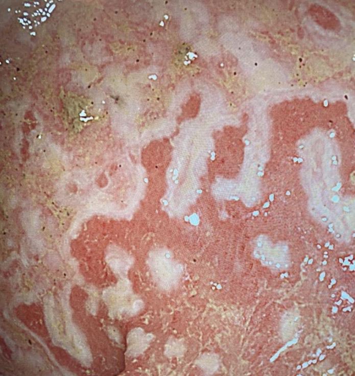 Colonoscopy images of an elderly patient with diarrhoea. What’s the diagnosis?