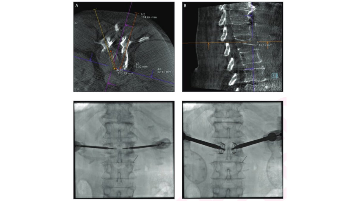 Andrew Rosenkrantz (@arosenkrantzmd) on Twitter photo New <a href="/AJR_Radiology/">AJR</a> Accepted Manuscript:
"Cone-Beam CT With Enhanced Needle Guidance and Augmented Fluoroscopy Overlay: Applications in Interventional Radiology"
By Drs <a href="/bkeyMD/">Brandon Key, MD</a>, <a href="/SeanTutton/">Sean Tutton</a>, & Scheidt <a href="/MCWRadiology/">MCW Radiology</a> <a href="/UCSDImaging/">UCSD Imaging</a>
ajronline.org/doi/abs/10.221… New <a href="/AJR_Radiology/">AJR</a> Accepted Manuscript:
"Cone-Beam CT With Enhanced Needle Guidance and Augmented Fluoroscopy Overlay: Applications in Interventional Radiology"
By Drs <a href="/bkeyMD/">Brandon Key, MD</a>, <a href="/SeanTutton/">Sean Tutton</a>, & Scheidt <a href="/MCWRadiology/">MCW Radiology</a> <a href="/UCSDImaging/">UCSD Imaging</a>
ajronline.org/doi/abs/10.221…