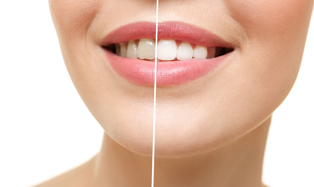 MedicinalFoods's tweet photo. Can You Reverse a Cavity
Can you reverse a cavity? You might have asked yourself many times. When it comes to oral health, this is one of the most problems faced by patients.
https://t.co/QQbercuZrN https://t.co/SwNH6tFfPI