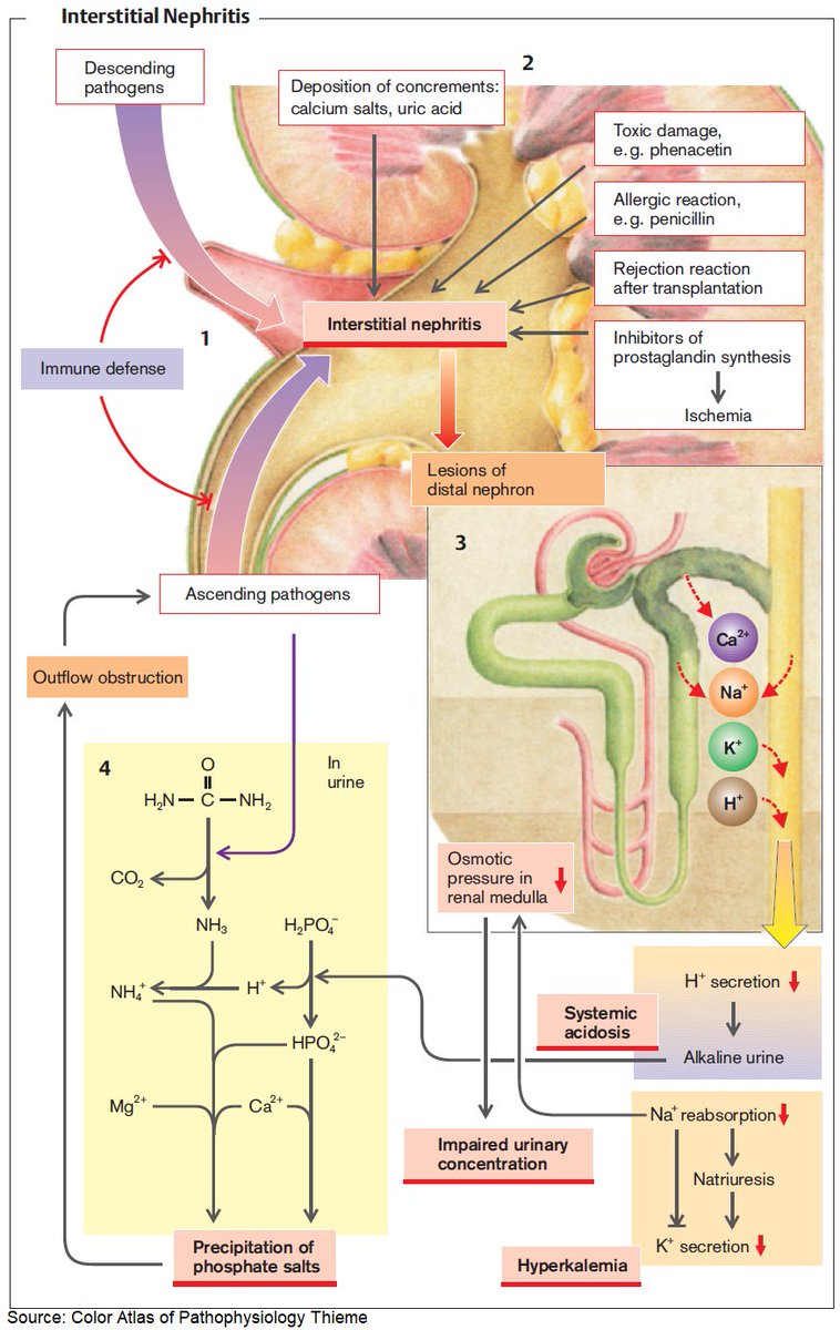 Pathophysiology of Interstitial Nephritis

#medtwitter #foamed #meded #nephrology