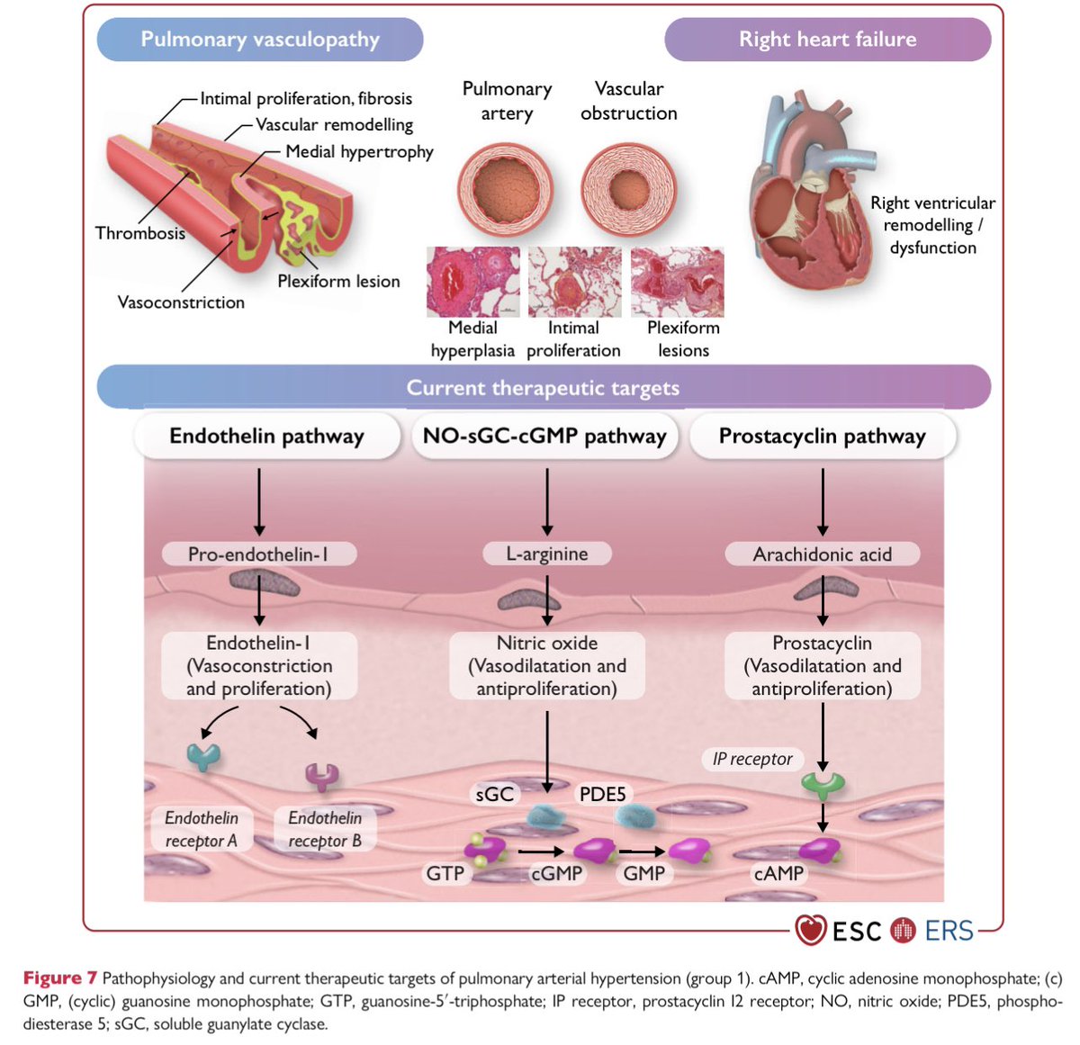 GiuseppeGalati_'s tweet photo. 🔥 #PulmonaryHypertension in #HeartFailure 2/2
🔍 Divided in:
- Isolated post-capillary #IpcPH
- Combined post- & pre-capillary #CpcPH
👉 Potential role of new drugs like #vericiguat that should be tested in both populations of #HF (#IpcPH & #CpcPH)
- NO-sGC-GMP pathway is 🔑 https://t.co/3ja8GRJRpY