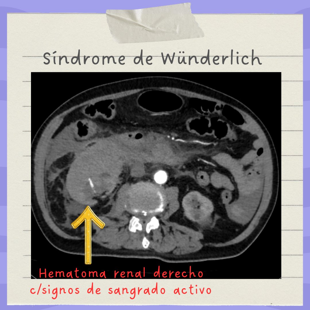 CEA_HIBA's tweet photo. Se realiza angiografía de urgencia con embolización de pseudoaneurisma renal. Compartimos dos perlas clínicas a raíz de este caso, el Síndrome de Wünderlich, entidad como se conoce este escenario y el manejo de la anticoagulación en pacientes usuarios de DOACs. https://t.co/iFJgHPcPEd