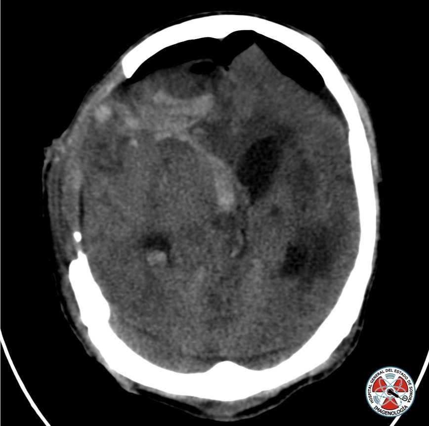 ¿Cuál es el nombre de este signo? #radres #radiology #ct <a href="/maxclarka/">Max Clark</a>