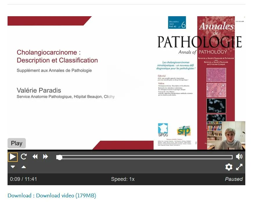 Annpathol's tweet photo. 🔬 Le numéro spécial des Annales de Pathologie sur les Cholangiocarcinomes est visionable &amp; téléchargeable gratuitement 
👉 https://t.co/SYjEksdKgg 
🎬 3 vidéos par V.Paradis, J.Selves et M.Delaye/C.Neuzillet
@valerie_paradis  @DelayeMatthieu 
#pathology #gipath #francophonepath https://t.co/iFYyauLuVR