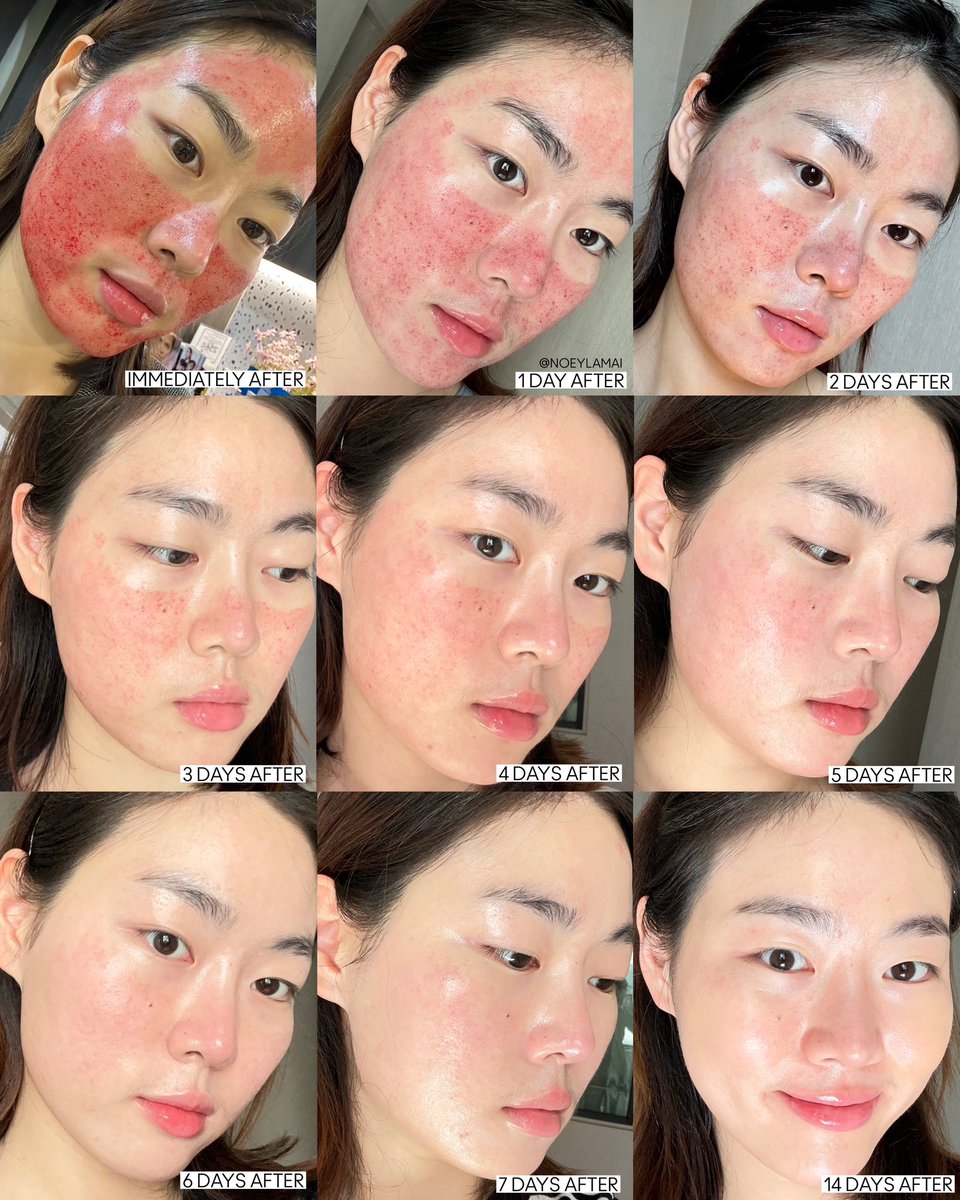 noeylamai's tweet photo. อัพเดทหลังทำ Pico laser สักหน่อย สำหรับเรามันดีมากๆๆ ถ้ามีเวลาพักหน้าอะ แนะนำเลย นี่ทำแล้ว พี่ทักว่าหน้าดีขึ้น แต่งหน้าเนียนขึ้นเยอะ รอยหายวับ ผิวใสขึ้นจริง เราทำที่ The loft clinic คุณหมอยิงละเอียดมากกก (มีต่อ) https://t.co/M86fxiALFY