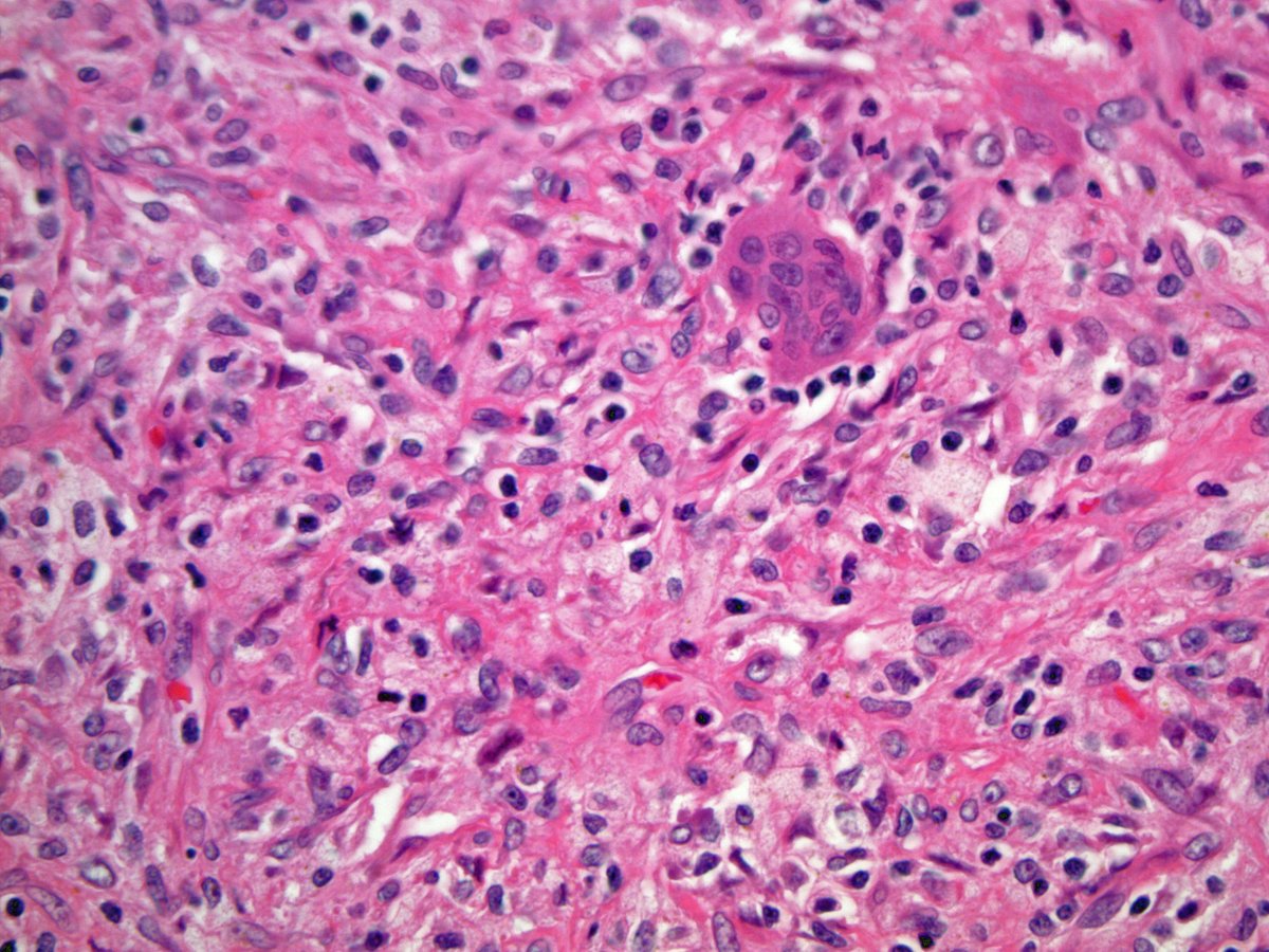 ScottBikeethan's tweet image. 20+ male with a well circumscribed subcut abdominal mass, associated with osteoclast-type giant cells, foamy histiocytes, fibrous pseudocapsule, and bland ovoid cells. Focal keratin positivity. What is your diagnosis? @CLEClinicLabs @CCFPathRes #BSTpath #pathology