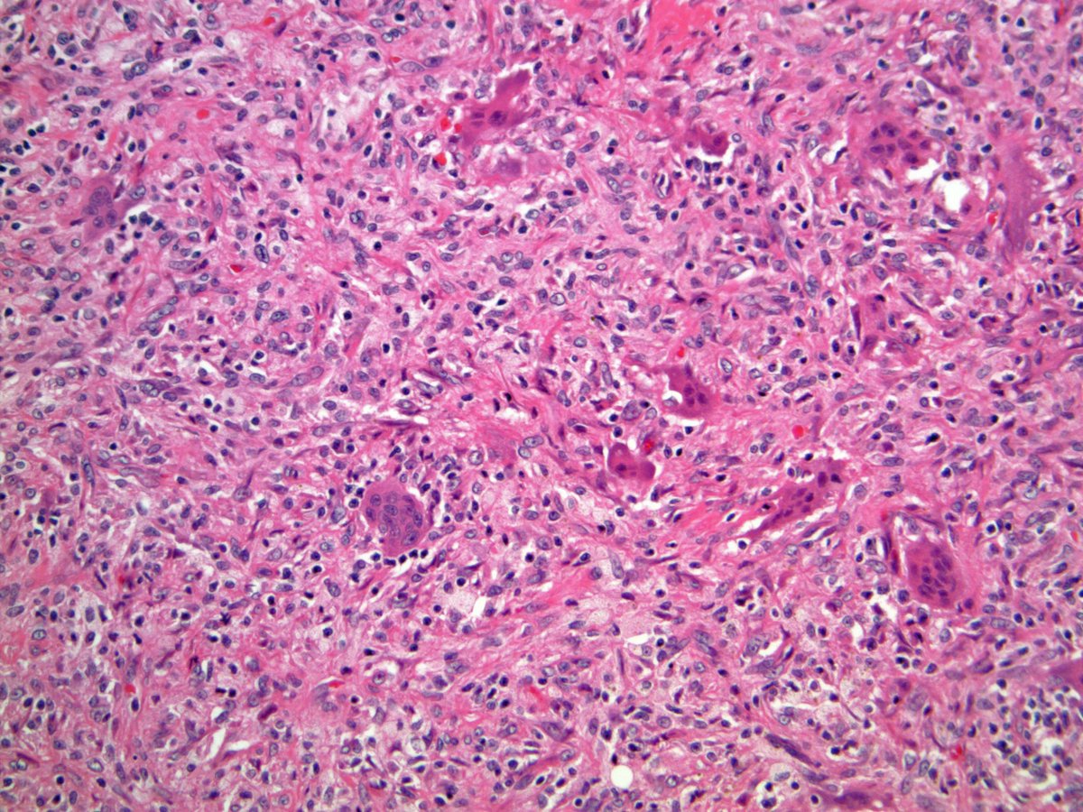 ScottBikeethan's tweet image. 20+ male with a well circumscribed subcut abdominal mass, associated with osteoclast-type giant cells, foamy histiocytes, fibrous pseudocapsule, and bland ovoid cells. Focal keratin positivity. What is your diagnosis? @CLEClinicLabs @CCFPathRes #BSTpath #pathology