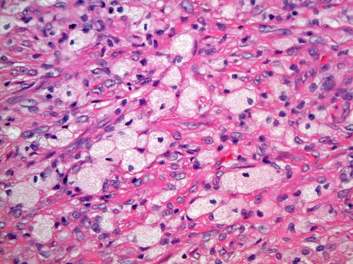 ScottBikeethan's tweet image. 20+ male with a well circumscribed subcut abdominal mass, associated with osteoclast-type giant cells, foamy histiocytes, fibrous pseudocapsule, and bland ovoid cells. Focal keratin positivity. What is your diagnosis? @CLEClinicLabs @CCFPathRes #BSTpath #pathology