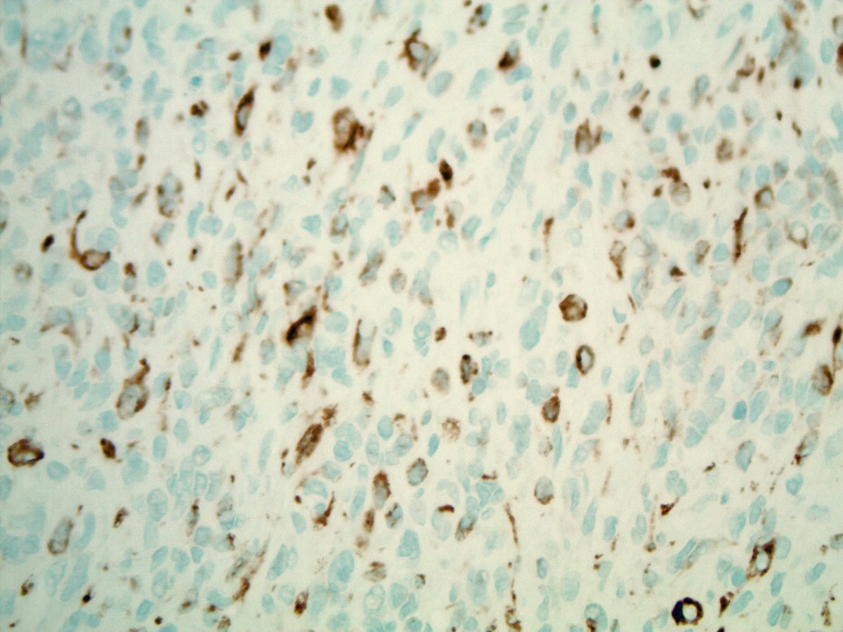 Scott Kilpatrick, MD (@scottbikeethan) on Twitter photo 20+ male with a well circumscribed subcut abdominal mass, associated with osteoclast-type giant cells, foamy histiocytes, fibrous pseudocapsule, and bland ovoid cells. Focal keratin positivity. What is your diagnosis? <a href="/CLEClinicLabs/">ClevelandClinicLabs</a> <a href="/CCFPathRes/">Cleveland Clinic Pathology Residency</a> #BSTpath #pathology 20+ male with a well circumscribed subcut abdominal mass, associated with osteoclast-type giant cells, foamy histiocytes, fibrous pseudocapsule, and bland ovoid cells. Focal keratin positivity. What is your diagnosis? <a href="/CLEClinicLabs/">ClevelandClinicLabs</a> <a href="/CCFPathRes/">Cleveland Clinic Pathology Residency</a> #BSTpath #pathology