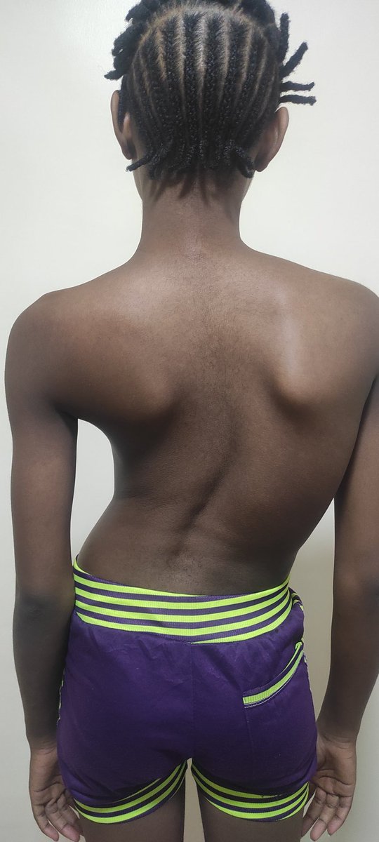 AMToluse's tweet photo. Scoliosis deformity correction surgery - BEFORE and AFTER #spinesurgery #scoliosis #spinehealth #deformitysurgery https://t.co/jd3xsc9uSh