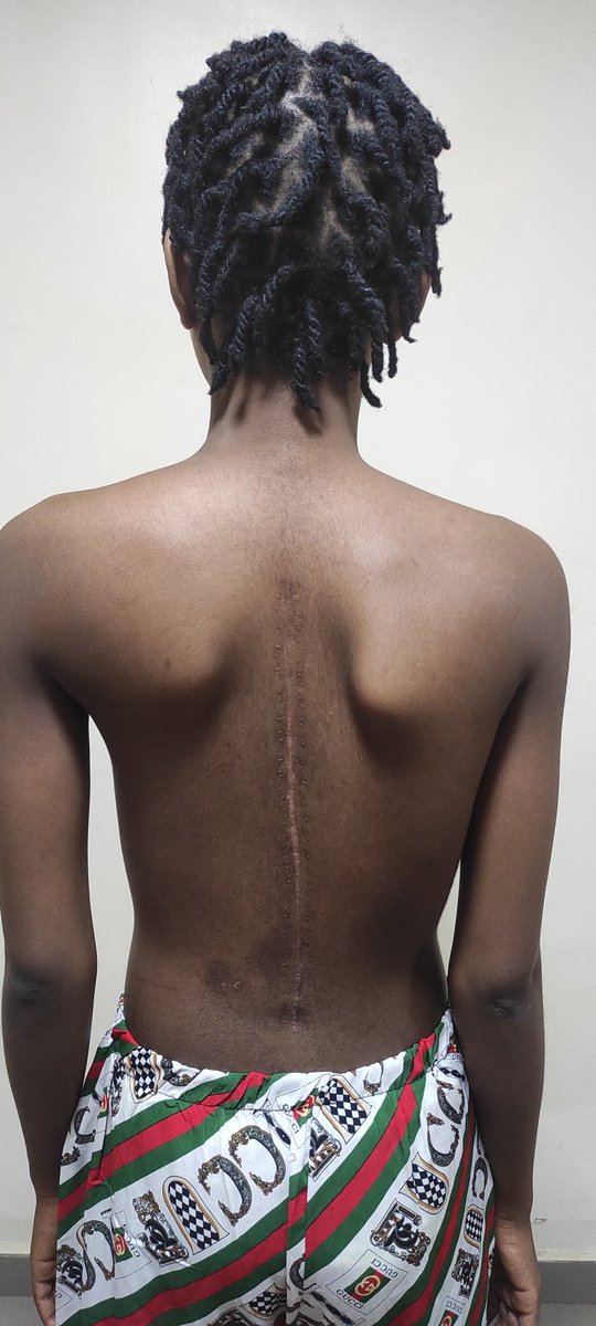 AMToluse's tweet photo. Scoliosis deformity correction surgery - BEFORE and AFTER #spinesurgery #scoliosis #spinehealth #deformitysurgery https://t.co/jd3xsc9uSh