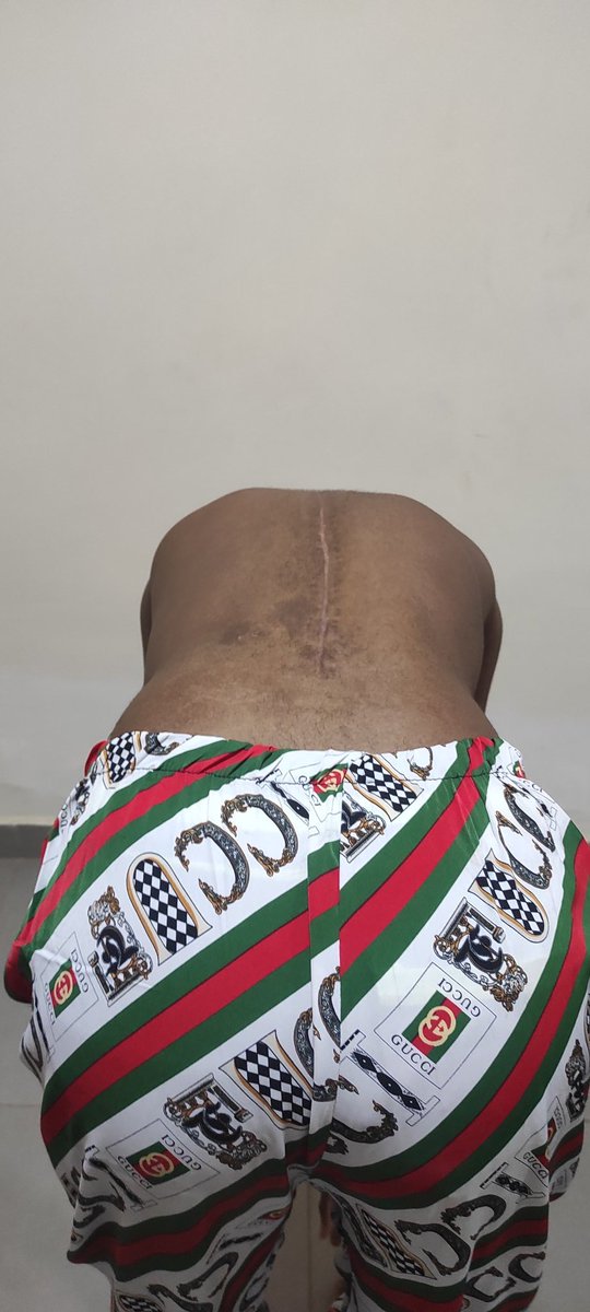 AMToluse's tweet photo. Scoliosis deformity correction surgery - BEFORE and AFTER #spinesurgery #scoliosis #spinehealth #deformitysurgery https://t.co/jd3xsc9uSh