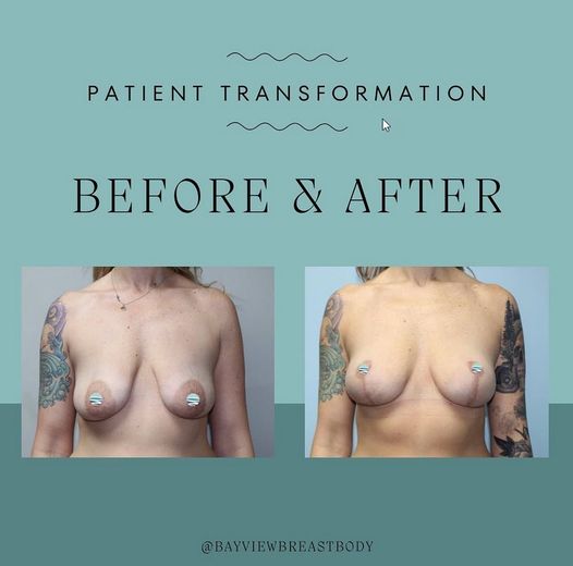 Mastopexy (breast lift) 6 weeks post-op.
Dr. Cohen was able to give this patient great shape without having to reduce or discard any of her breast tissue. Another beautiful result!
bayviewplasticsurgery.com/proced.../brea…
#breastlift #mastopexy #plasticsurgery #boardcertifiedplasticsurgeon