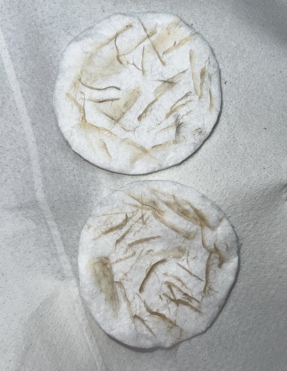 Chloenight_'s tweet photo. 𝓓𝓮𝓻𝓶𝓪𝓹𝓵𝓪𝓷𝓲𝓷𝓰 𝓕𝓪𝓬𝓲𝓪𝓵
SWIPE FOR  RESULTS😍

Benefits:
-Removes dead skin cells/dirt
-Removes ‘peach fuzz’
-Best form of exfoliation
-Hair does not grow back thicker or darker
-Instant results
-Leaves skin looking radiant and glowy
-Better makeup application https://t.co/Y30mxXBanp