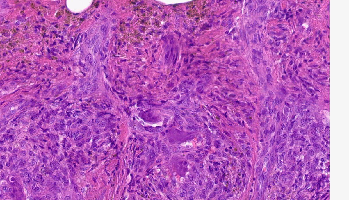 plexiform fibrohistiocytic tumor are fascinating entities!!!
<a href="/Joaomgama/">João Gama</a>