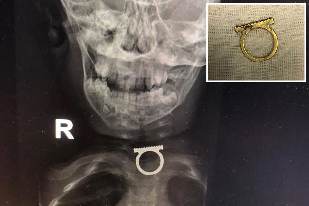 new-york-post-on-twitter-my-2-year-old-swallowed-my-ring-here-s-how