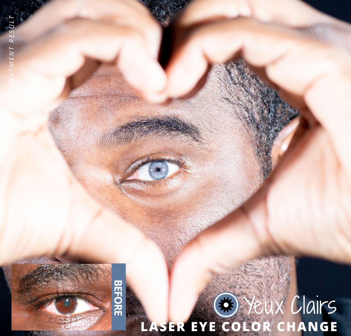 yeuxclairslaser's tweet photo. Laser eye color change.
*This image shows a real treatment result.
More results: https://t.co/efSDuD9LYk
#yeuxclairs #eyecolorchange #yeuxpatient #laser #yeux #yc #realresult https://t.co/fmknc1Dc1v