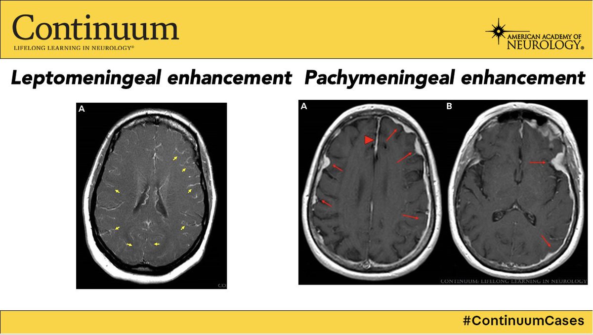 caseyalbin's tweet photo. In lieu of the traditional #continuumcases format, I just wanted to highlight how this issue features so many classic imaging examples of neuropathology!
As a trainee I would wonder, but what exactly am I looking for?
Relate? Start w/ this article 👇 https://t.co/IDXNHossu6 https://t.co/sbPwLavBqL