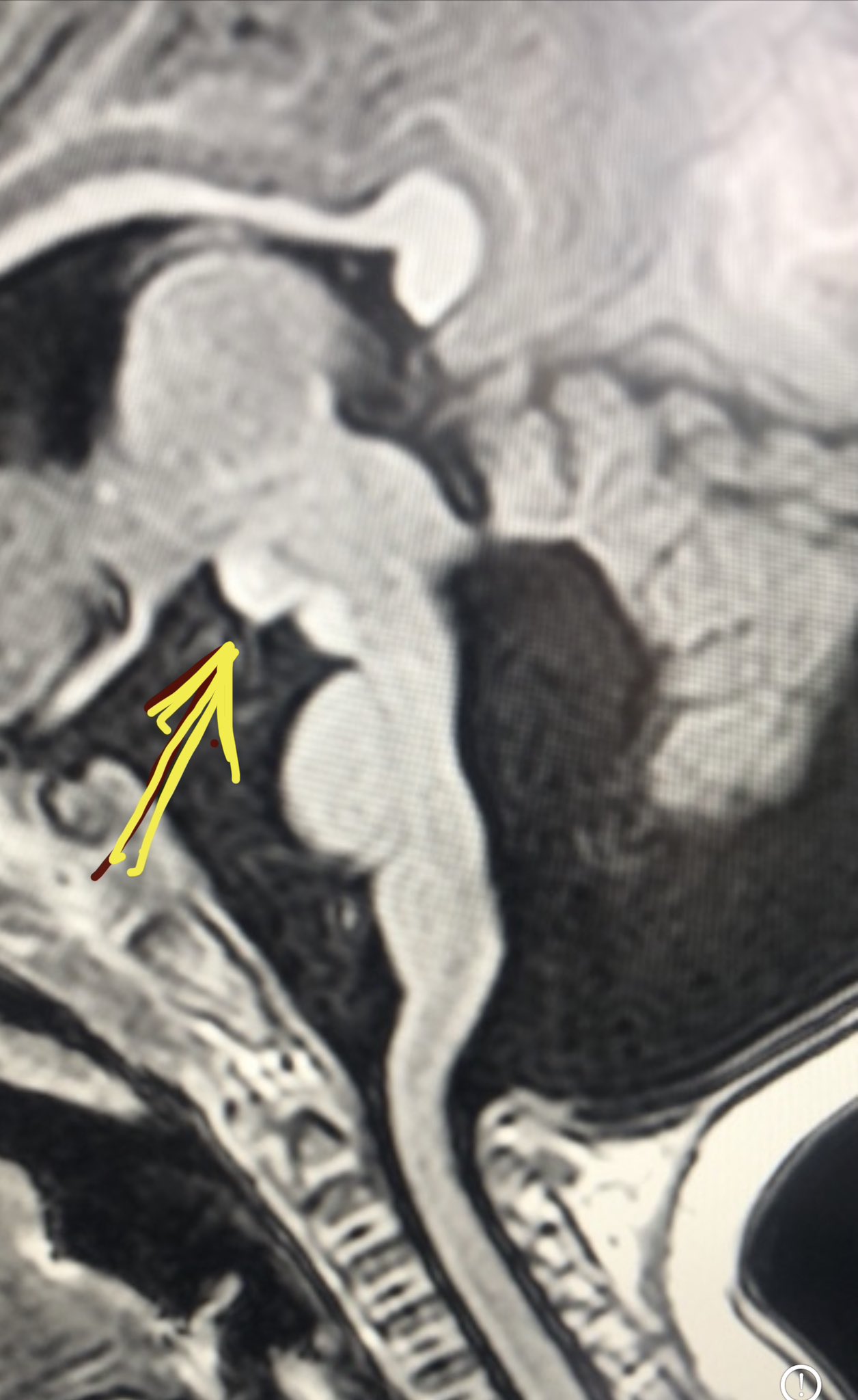 Dr Kish Mankad on Twitter "Tip of the day 💡 Targeted screening for Jouberts syndrome should be