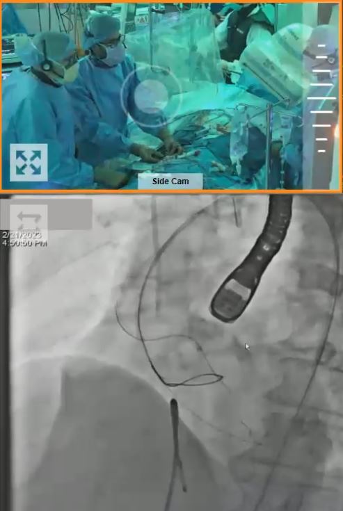 First-in-human TELLTALE-BASILICA @StFrancis_LI! TELLTALE is the first and only dedicated system for transcatheter electrosurgical leaflet modification. Life is so much easier with dedicated devices - BASILICA took only a few minutes and the patient did great! Details at #crt2023