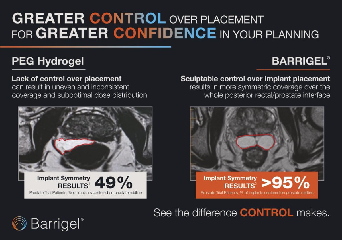 2nd generation Rectal spacer
NASHA <a href="/Barrigel_spacer/">Barrigel</a> 
Lifting strength 
and sculptural and 
touch up capability is superior than hydrogel
#SBRT #photontherapy  #prostatecancer