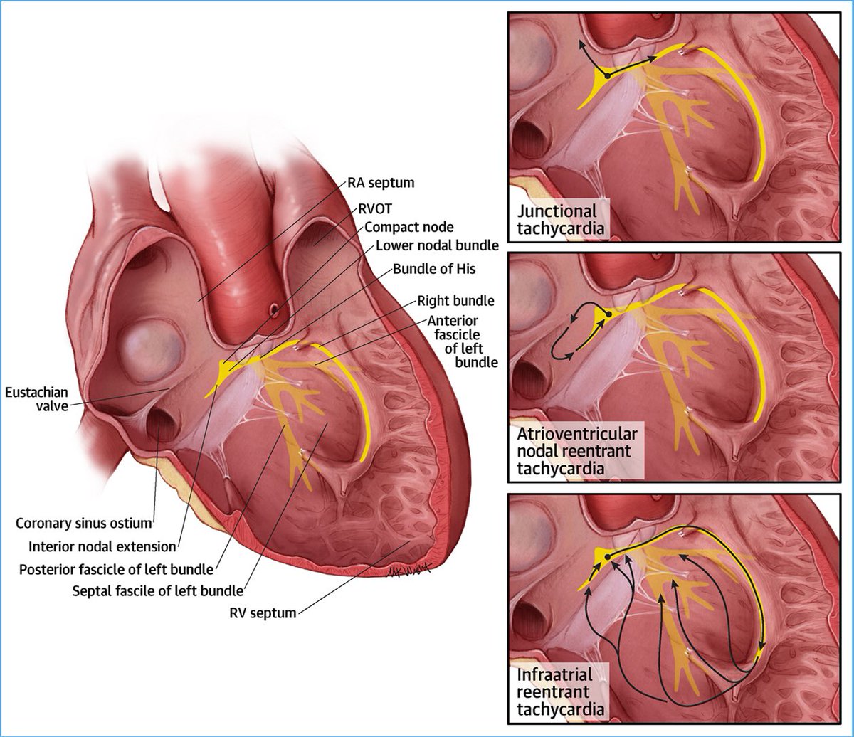 A masterpiece from my colleagues @ClevelandClinic @CCFcards with new insights into JT, AVNRT and infra-atrial re-entry in @JACCJournals . Amazing images! Must read for all EPs #EPeeps jacc.org/doi/full/10.10…