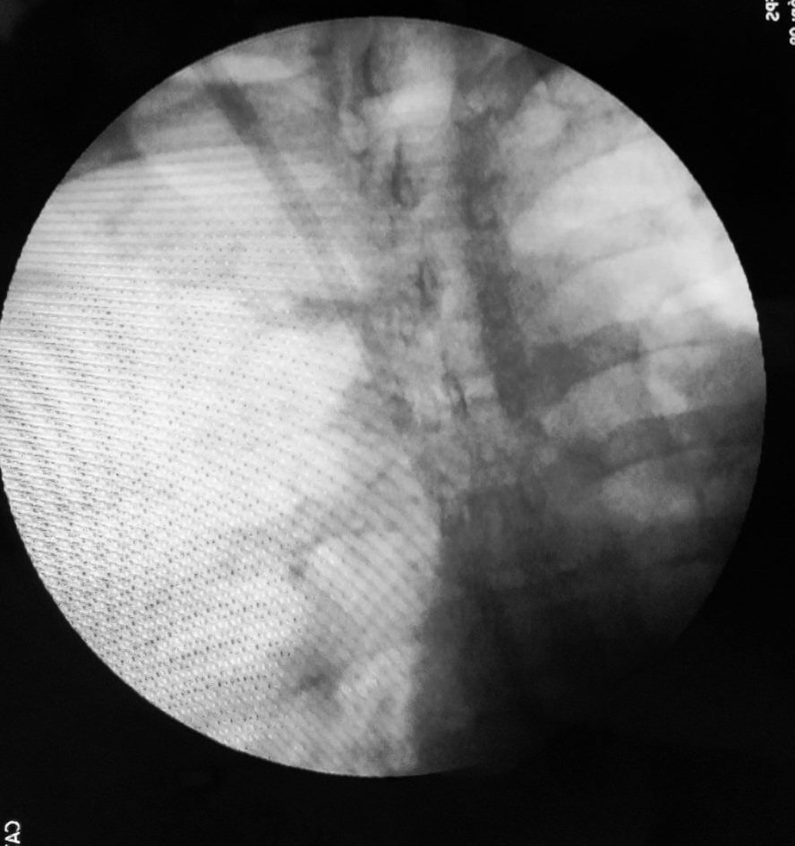 MartinVargas89's tweet photo. Misplacement of Tunneled Hemodialysis Catheter into subclavian vein and replacement of catheter with fluoroscopy.
#nefrus
#InterventionalNephrology https://t.co/zRaygY31N0