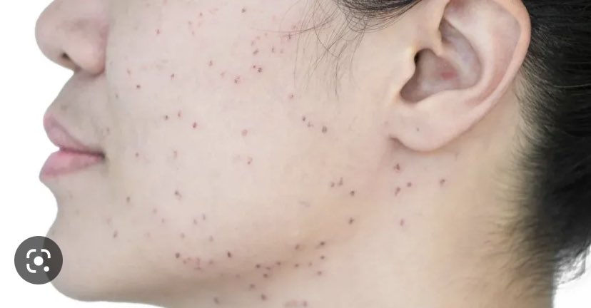 What causes dark/black spots on our face ??? 🤔