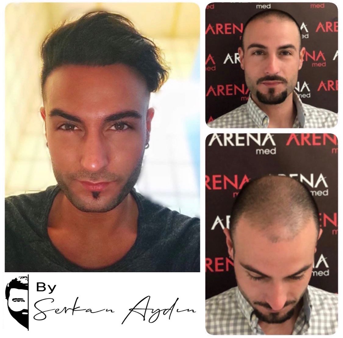 Arenamedd's tweet photo. #serkanaydin #arenamed #saçlıseferleri #hayallerdökülmez #srk #hayallerdökülmezsrk #hayallerdökülmezserkanaydın
#saçaatılanimzaserkanaydın #thesignatureonhairserkanaydın #saçaatılanimza #thesignatureonhair #srkline 🧿👍 https://t.co/Z6f41zvMpR
