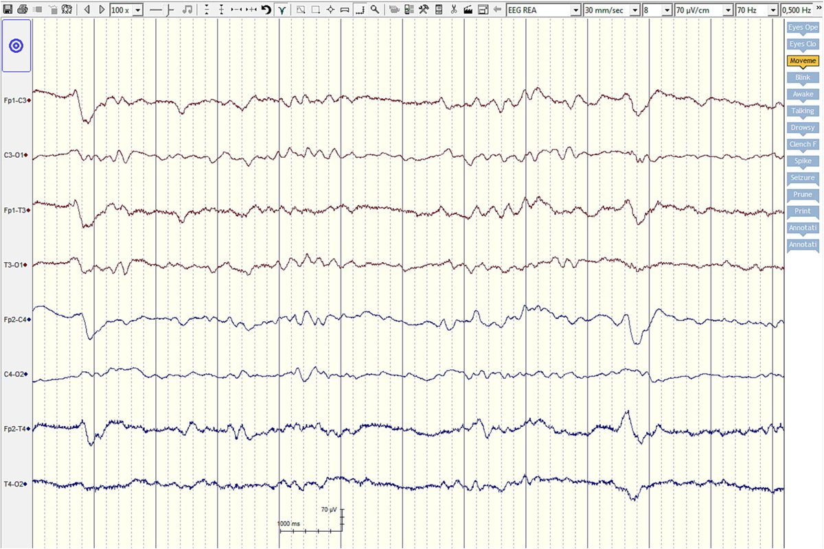 IFCN and its Clinical Neurophysiology journals tweet media