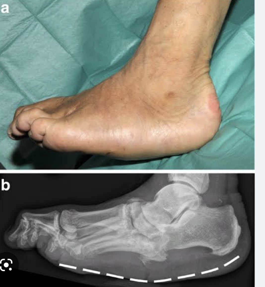 OlusegunOyeniy2's tweet photo. @BrownJHM Charcot foot-a disabling disorder caused as a result of nerve damage in the feet (peripheral neuropathy) e.g type 1 diabetes,there 3 stages of charcot neuroarthropathy(acute ie destructive,sub acute ie repatative, &amp; chronic ie stable).Dx-X-ray,Tx-cast for foot &amp; ankle,surgery . https://t.co/mLcbaBpsWX