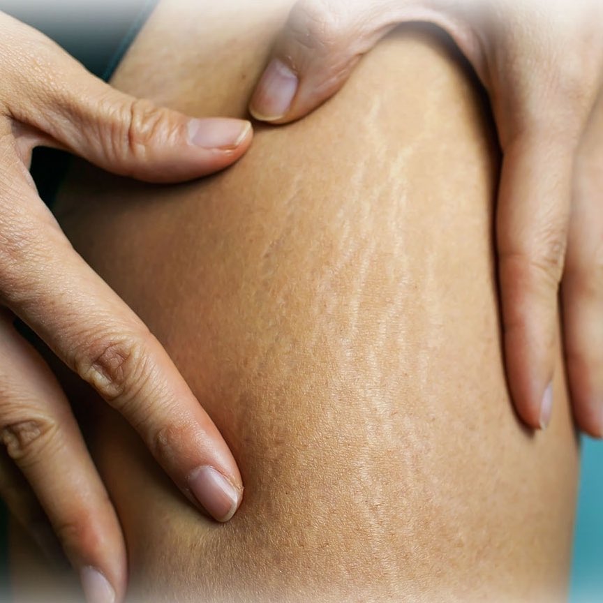 secretlyfura's tweet image. basically, if your skin looks like this, you kena mula exfoliate badan. 2-3x/ seminggu dah cukup. never skip this weekly routine kalau nak badan halus, smooth and acne-free 💯