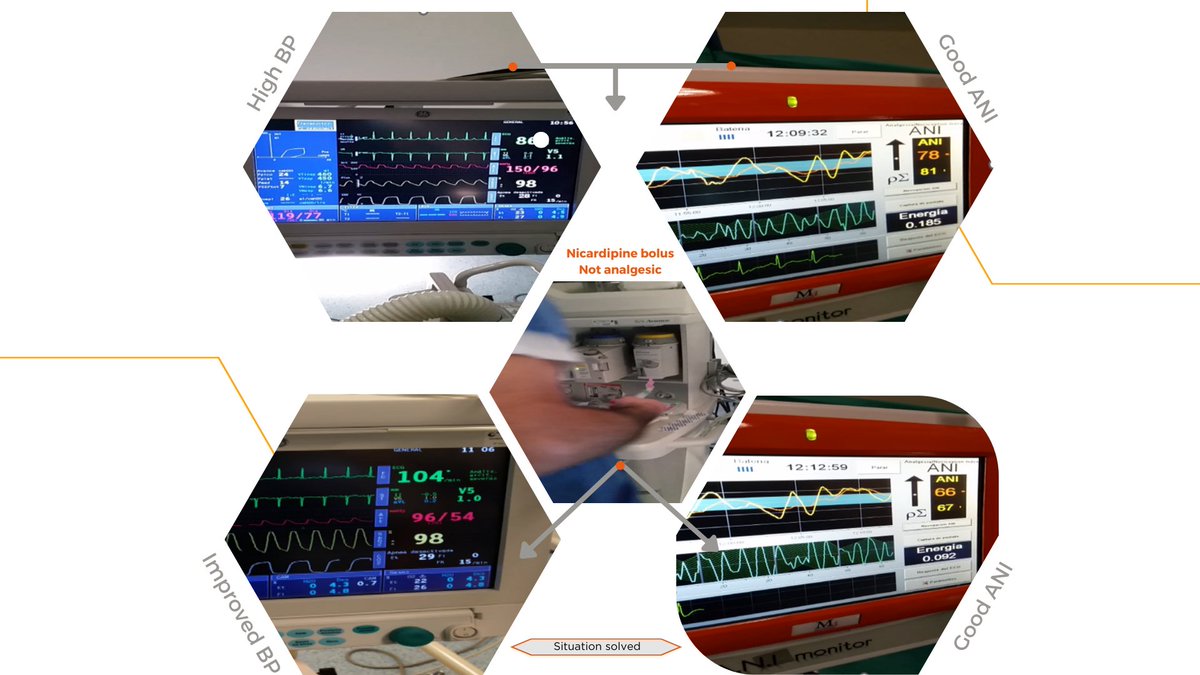 MdolorisMedical's tweet photo. High BP in a patient may suggest pain, but ANI assessment revealed adequate analgesia. Administering nicardipine lowered BP, but ANI remained stable, ruling out low analgesia as the cause of hypertension. https://t.co/pAjDv03F5M