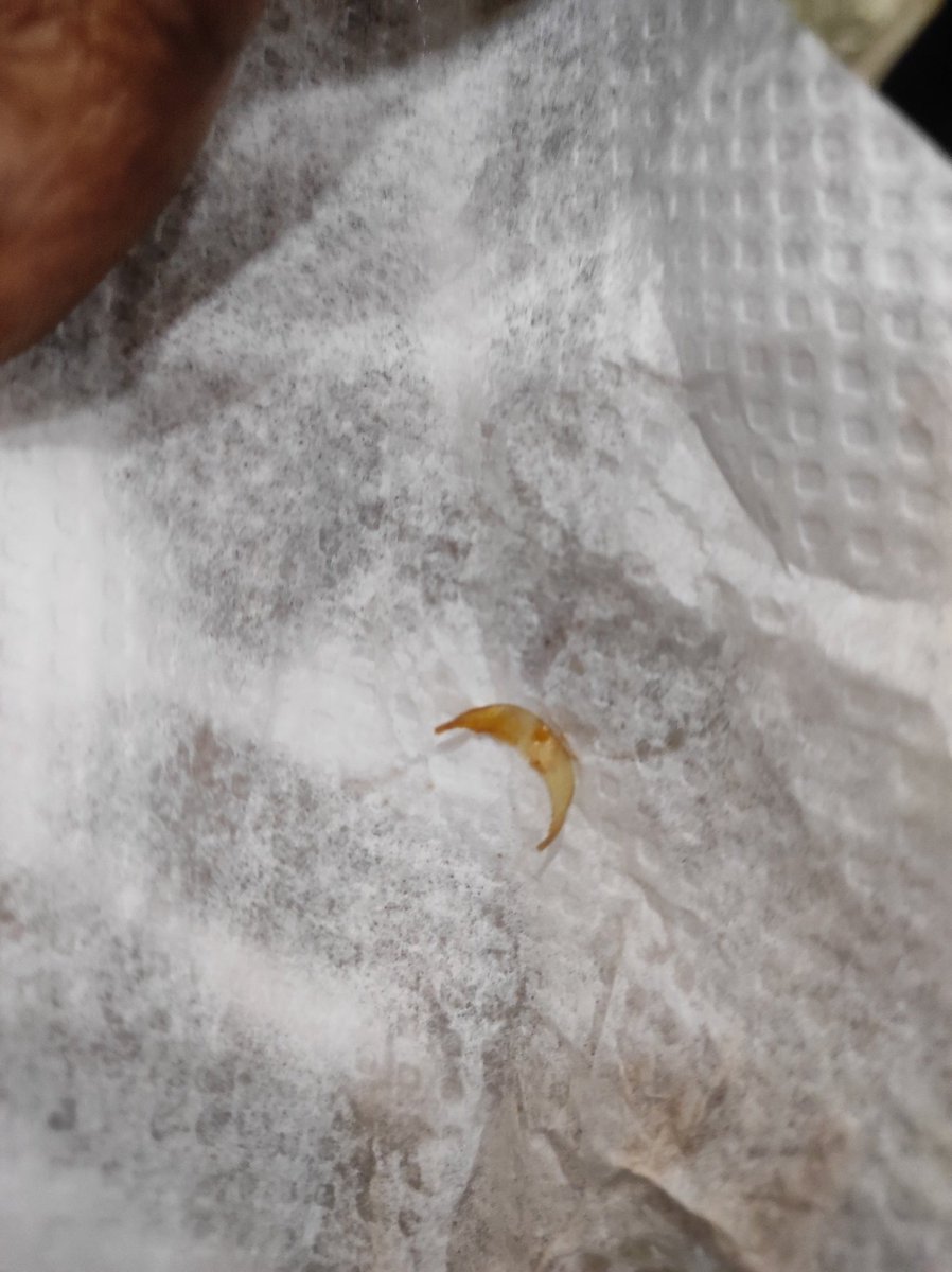 Ashrafmulla71's tweet photo. Fingernail found in jumbo chicken Burger at Burger camp Branch, pune
#fssai, #fssai https://t.co/QzV1zfP0JO