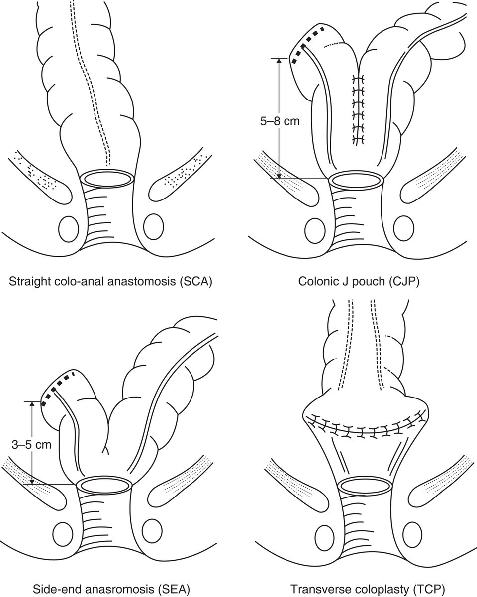 In March's BJS: Reconstructive techniques following low anterior resection for carcinoma of the rectum: meta-analysis academic.oup.com/bjs/article/11… <a href="/bplwijn/">Bas Wijnhoven</a> <a href="/des_winter/">Des Winter</a> <a href="/ksoreide/">Kjetil Søreide</a> <a href="/MalinASund/">Malin Sund</a> <a href="/evanscolorectal/">Martyn Evans</a> <a href="/nfmkok/">Niels Kok</a> <a href="/paulo_sutt/">Paul Sutton</a> <a href="/robhinchliffe1/">Robert Hinchliffe</a> <a href="/young_bjs/">Young BJS</a>