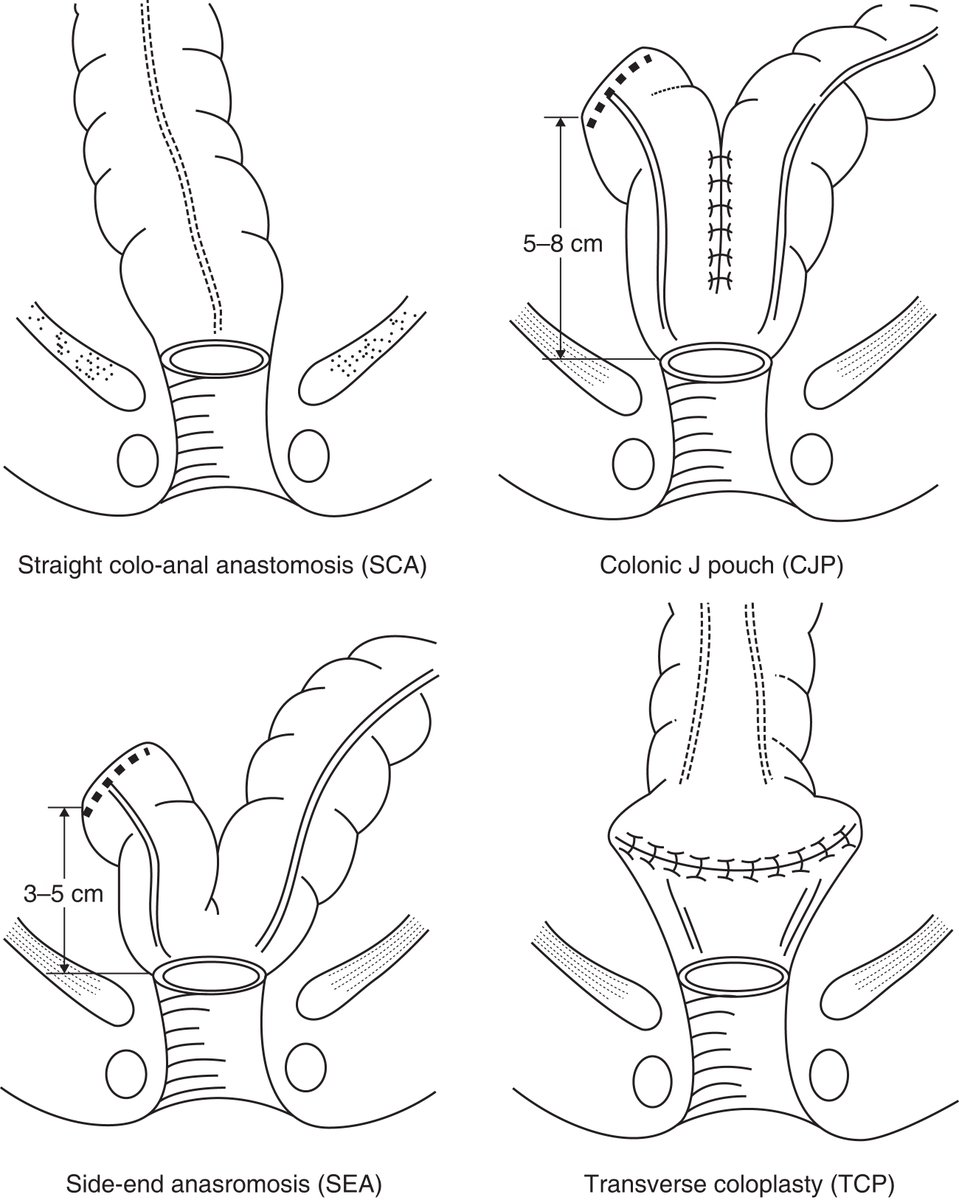 In March's BJS: Reconstructive techniques following low anterior resection for carcinoma of the rectum: meta-analysis academic.oup.com/bjs/article/11… @bplwijn @des_winter @ksoreide @MalinASund @evanscolorectal @nfmkok @paulo_sutt @robhinchliffe1 @young_bjs