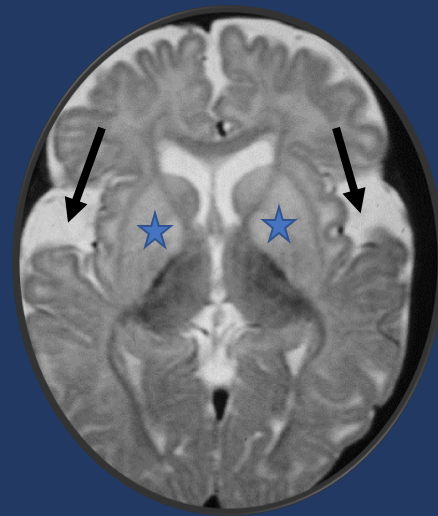 Tip of the day 💡: Not many causes of a large head a leukodystrophy! Once you pick up signal changes in the basal ganglia and the open opercula (arrows), you have clinched the diagnosis of Glutaric Aciduria Type 1. Do you know which other leukodystrophies accompany large heads?